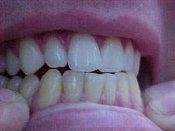 bar à sourire, N°1 en blanchiment dentaire éclat'dent